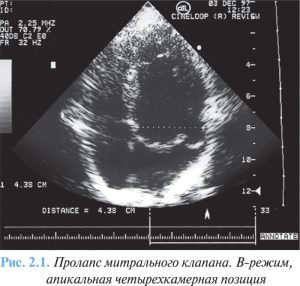 Пролапс митрального клапана диагностика