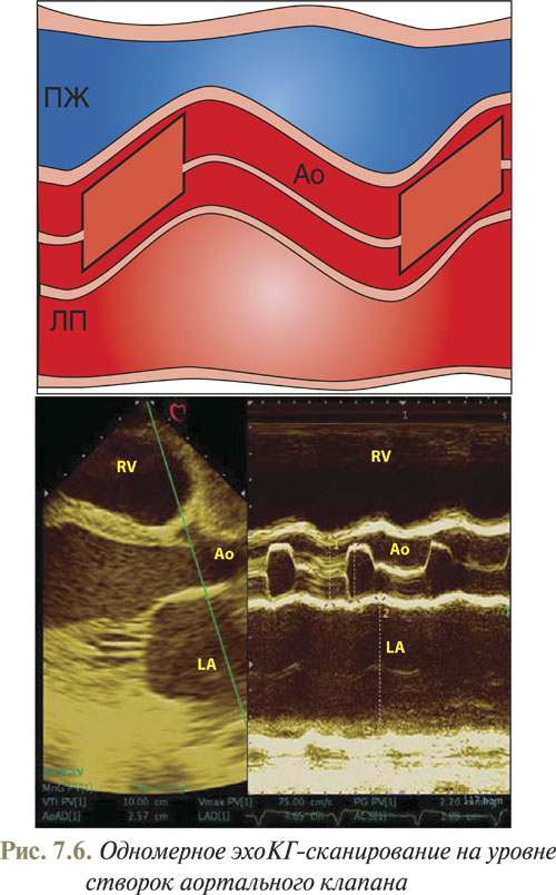 Аортальный клапан в парастернальном доступе по короткой оси