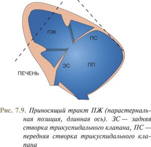 Отрыв хорды трикуспидального клапана